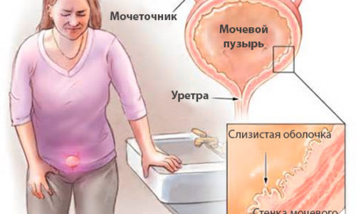 Симптомы и признаки воспаления мочевого пузыря