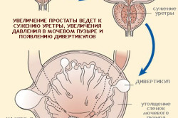 Схема появления дивертикулов Схема появления дивертикулов