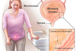 Схема цистита