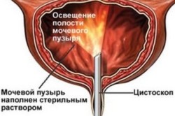 Цистоскопия мочевого пузыря
