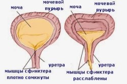 Схема гиперактивного мочевого пузыря