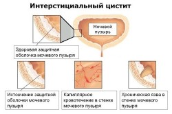 Механизм развития интерстициального цистита