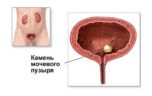 Как правильно подготовиться к УЗИ почек и мочевого пузыря?