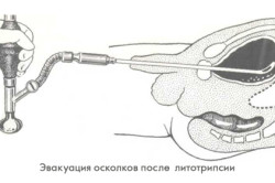 Принцип трансуретральной цистолитолапаксии