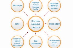 Причины развития цистита