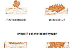 Разновидности рака мочевого пузыря